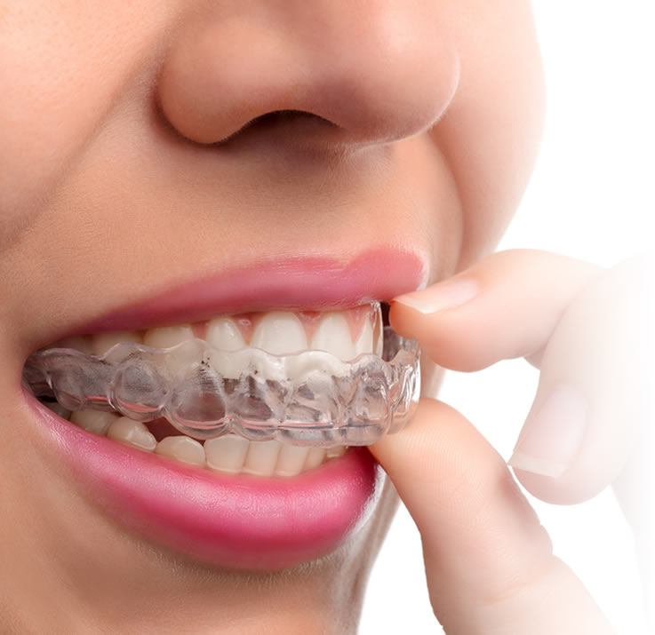 Telsiz Ortodonti Invisaling Sistemi